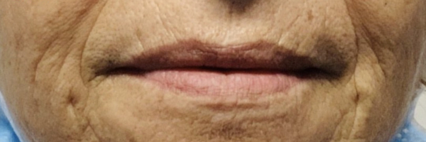 Lip fillers Before & After Image