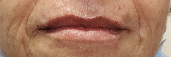 Lip fillers Before & After Image