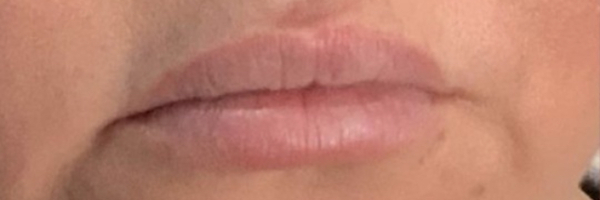 Lip fillers Before & After Image