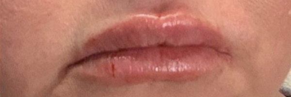 Lip fillers Before & After Image