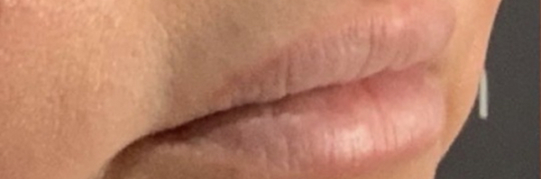 Lip fillers Before & After Image
