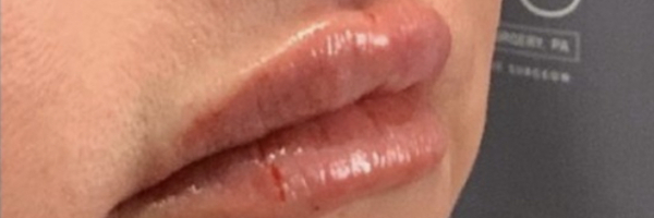 Lip fillers Before & After Image