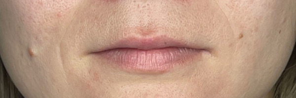 Lip fillers Before & After Image