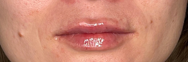 Lip fillers Before & After Image