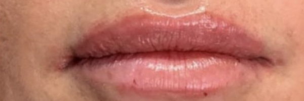 Lip fillers Before & After Image