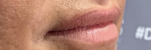 Lip fillers Before & After Image