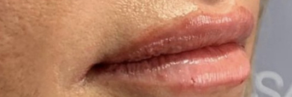 Lip fillers Before & After Image