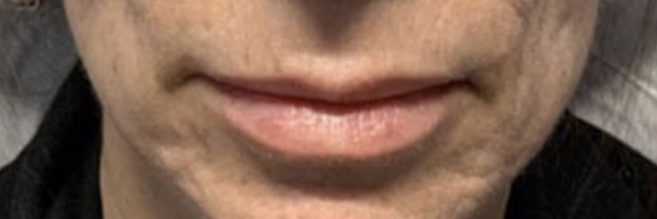 Lip fillers Before & After Image