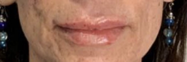 Lip fillers Before & After Image