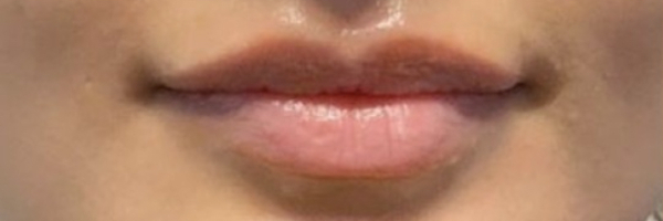 Lip fillers Before & After Image