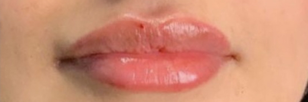 Lip fillers Before & After Image