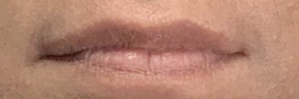 Lip fillers Before & After Image