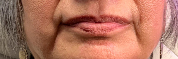 Lip fillers Before & After Image
