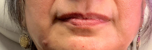 Lip fillers Before & After Image