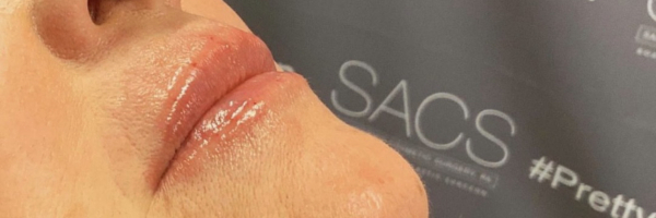 Lip fillers Before & After Image