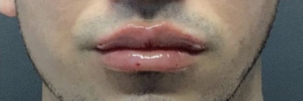 Lip fillers Before & After Image