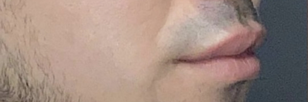 Lip fillers Before & After Image