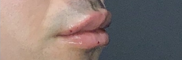 Lip fillers Before & After Image
