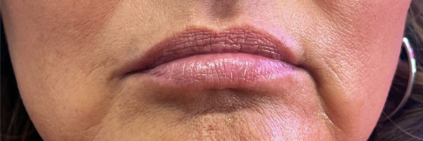 Lip fillers Before & After Image