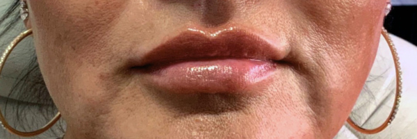 Lip fillers Before & After Image