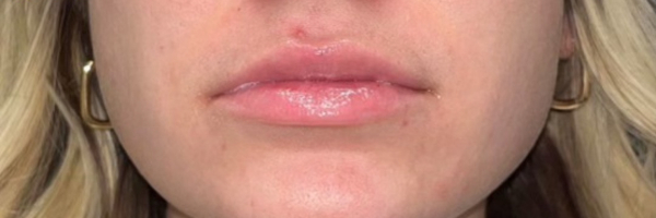 Lip fillers Before & After Image