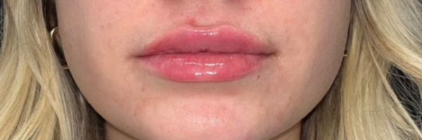 Lip fillers Before & After Image