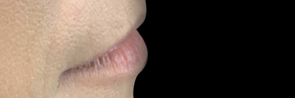 Lip fillers Before & After Image