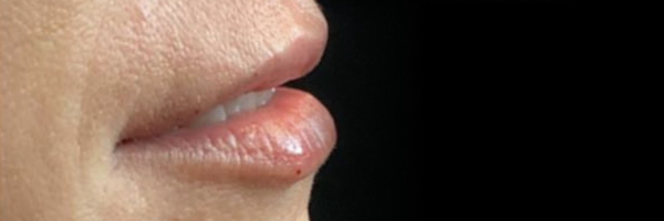 Lip fillers Before & After Image