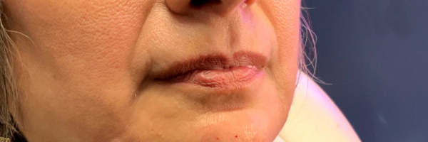 Lip fillers Before & After Image