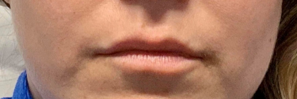 Lip fillers Before & After Image