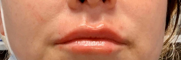 Lip fillers Before & After Image