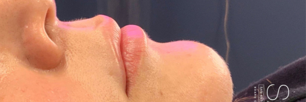 Lip fillers Before & After Image