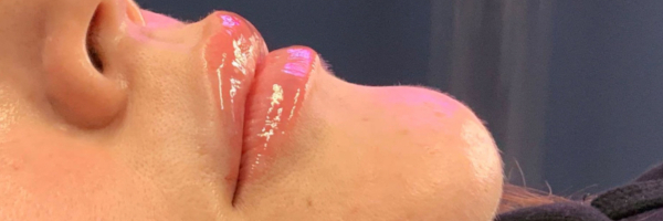 Lip fillers Before & After Image